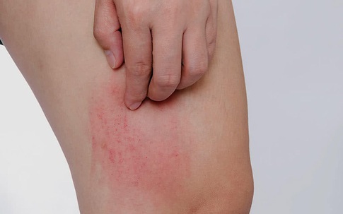 Ngứa "như điên", tưởng ung thư hoá ra vì... hanh, lạnh