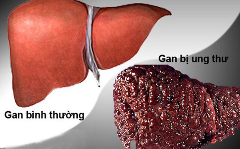 Cô gái 32 tuổi sốc khi phát hiện ung thư gan sau khi có biểu hiện mẩn ngứa, khô mắt