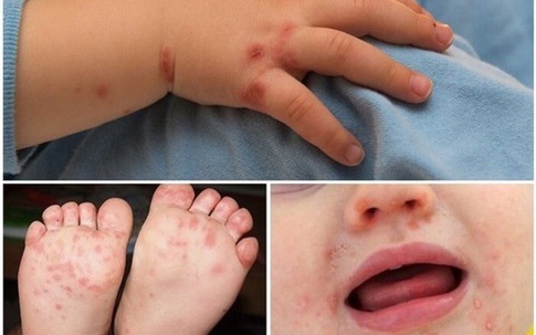 Hà Nội: Dịch chân tay miệng đang gia tăng, chủ yếu ở trẻ dưới 5 tuổi