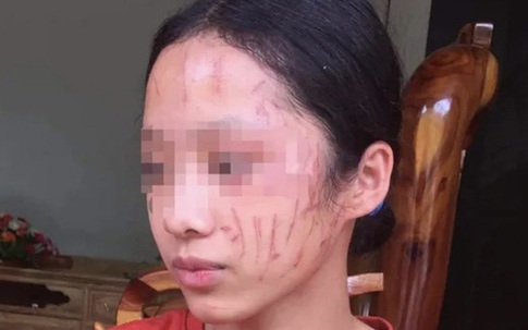 Nữ sinh cào nhau nát mặt, hai gia đình tự giảng hòa