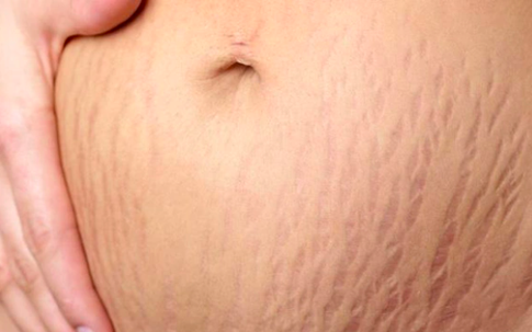 Sai lầm thường gặp khi điều trị rạn da trước và sau sinh