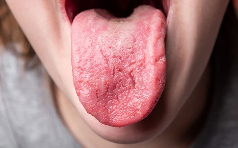 3 bất thường ở lưỡi tố cáo bệnh cao huyết áp, hãy tự kiểm tra và đến gặp bác sĩ sớm nhất có thể