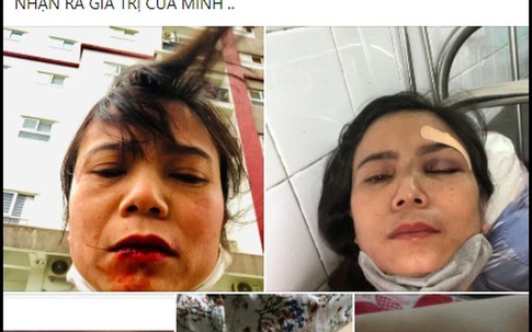Bị chồng đánh nhập viện, cô vợ bức xúc vạch tội toàn bộ nhà chồng, từ việc không ở chung vẫn phải đóng tiền ăn đến hành động hắt muối của mẹ chồng