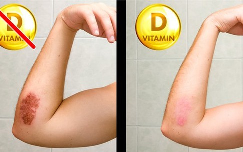 8 dấu hiệu của cơ thể nhắc nhở bạn cần bổ sung ngay vitamin D