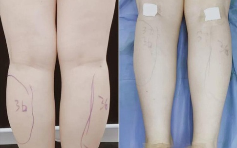 Ham có đôi chân nuột nà, thon gọn, cô gái quyết định đến cơ sở thẩm mỹ để cắt dây thần kinh