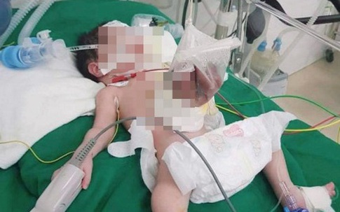 Nghệ An: Cứu sống bé sơ sinh có nội tạng nằm ngoài ổ bụng