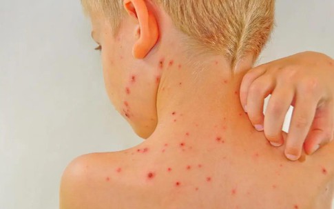 Sử dụng bộ đôi thảo dược “trong uống - ngoài bôi” cải thiện bệnh thủy đậu - Xu hướng mới được nhiều người lựa chọn