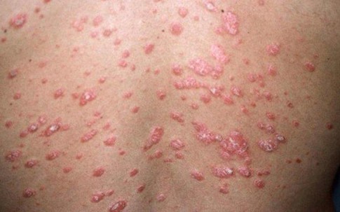 Giải pháp nào giúp cải thiện bệnh vảy nến thể giọt?