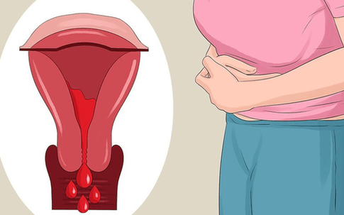 Niêm mạc tử cung lạc chỗ và dấu hiệu nhận biết sớm