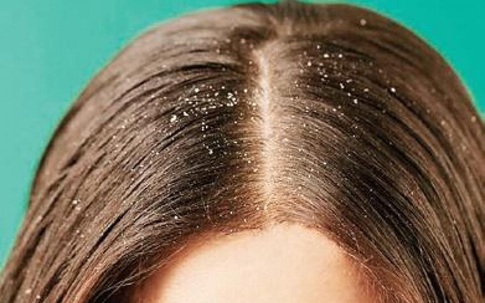 9 thói quen hằng ngày khiến đầu bạn gàu nhiều nhưng chẳng mấy ai để tâm vì cứ cho đó là vô hại