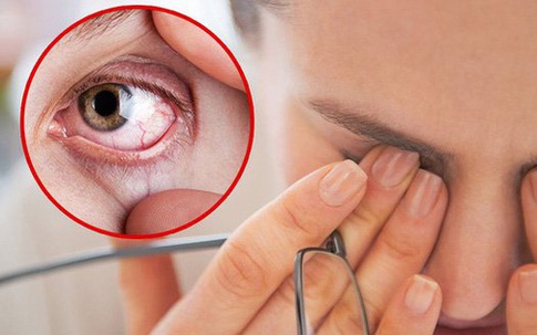 3 biểu hiện bất thường ở mắt ngầm cảnh báo gan có vấn đề, xem thử bạn có dấu hiệu nào hay không