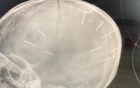 Thông tin mới nhất vụ bé gái 3 tuổi bị 9 vật nhọn giống đinh cắm vào hộp sọ, nghi bị bạo hành 