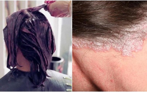 Những lưu ý tránh tóc 'ướp hóa chất' rụng cả mảng, sưng tấy da đầu khi làm đẹp đón Tết