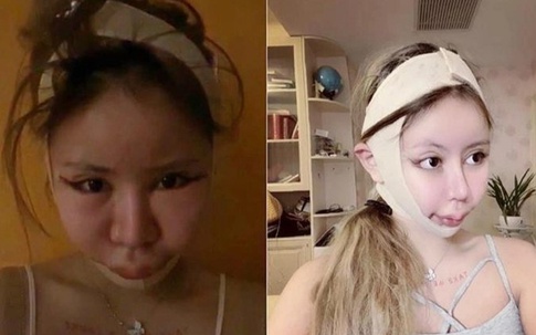 Người mẹ Nhật Bản ép con gái 9 tuổi cắt mí, làm mũi, nâng ngực