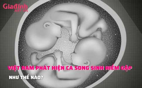Việt Nam ghi nhận ca song thai hiếm thứ hai trên thế giới như thế nào?