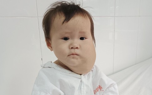 MS 807: Xót xa bé gái dân tộc H’Mông 1 tuổi có khuôn mặt biến dạng vì khối u lớn