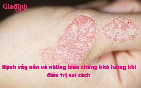 Bệnh vảy nến và những biến chứng khó lường khi điều trị sai cách