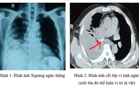 Mỏ gà chui vào phế quản do sặc, nam thực khách được các bác sỹ cứu thành công khi bị nhiễm trùng nặng