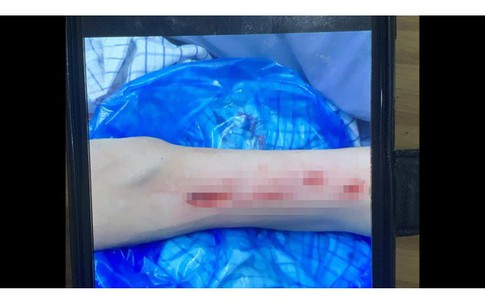 Cầm cố xe máy của bạn lấy tiền tiêu xài, thanh niên tự rạch tay hoang báo bị cướp