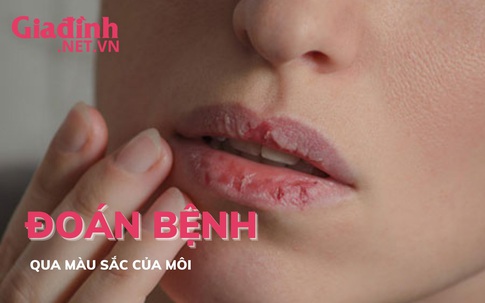 Đoán bệnh qua màu sắc của đôi môi