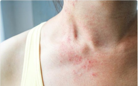 Tự ti vì da nổi mụn, mẩn đỏ trông ‘bẩn bẩn’ hậu COVID-19, nhiều chị em chữa sai cách khiến tình trạng nặng thêm