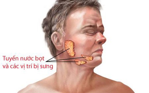 Nắng nóng, nhiều người nhập viện vì căn bệnh tưởng chỉ có trẻ con mới mắc