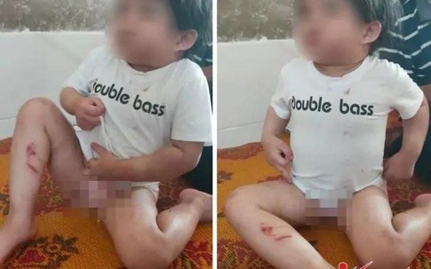 Công an thông tin vụ dì ruột đánh cháu 4 tuổi nhập viện vì lười ăn