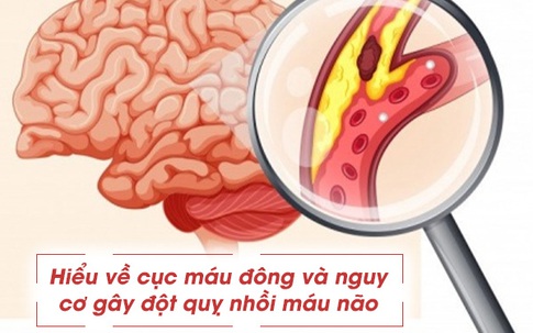 Hiểu về cục máu đông và nguy cơ gây đột quỵ nhồi máu não