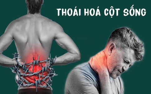 3 thói quen thường gặp là 'vua bào mòn' cột sống: Bác sĩ cảnh báo đau âm ỉ kéo dài ở 2 vùng này thì phải khám ngay kẻo muộn