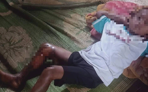 Vụ bé 8 tuổi bị đốt chân: Thông tin chính thức từ công an