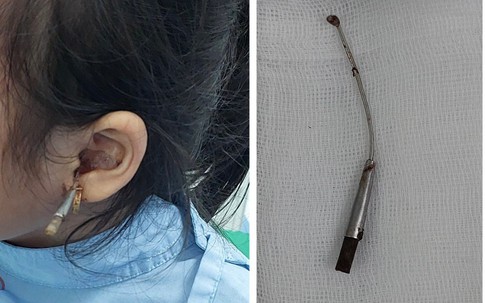 Từ vụ bé gái 6 tuổi bị que lấy ráy tai đâm xuyên tai, chuyên gia chỉ rõ nhiều người đang "đối xử tệ" với đôi tai của mình mà vẫn nghĩ đang làm đúng