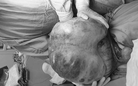 Cô gái 30 tuổi có khối u buồng trứng hơn 13kg và lời cảnh báo việc làm quan trọng là phụ nữ nhất định phải nhớ!