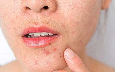Vì sao sau Tết nhiều chị em bị 'xấu đi'?
