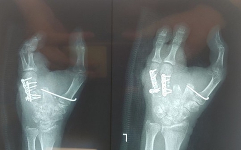 Kỳ diệu, bác sĩ "biến" ngón chân thành ngón tay cho người bị dập nát tay do tai nạn máy xay thịt