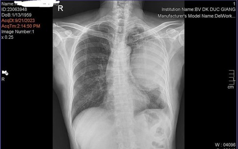 Người đàn ông 64 tuổi mất 1 lá phổi do thói quen hàng triệu nam giới Việt vẫn làm