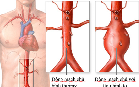 Căn bệnh khiến nghệ sĩ Bảo Anh 'Người đẹp Tây Đô' qua đời ở tuổi 68 mắc phải nguy hiểm thế nào?