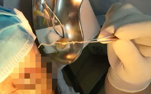 Phát hiện con giun dài 10cm còn sống trong mắt người phụ nữ