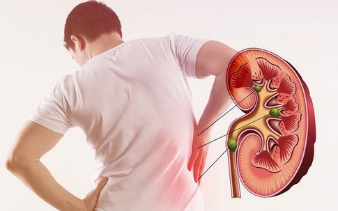 Thanh niên 20 tuổi bất ngờ phát hiện mắc hội chứng thận hư dù không có triệu chứng, đây là biến chứng đáng sợ nếu không điều trị đúng cách!
