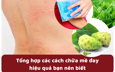 Tổng hợp các cách chữa mề đay hiệu quả bạn nên biết