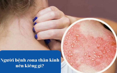 Người bệnh zona thần kinh kiêng gì và cách giúp cải thiện bệnh hiệu quả