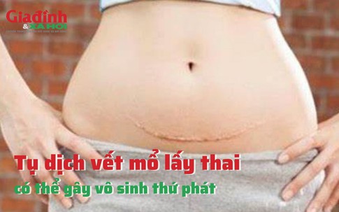 Tụ dịch vết mổ lấy thai có thể gây vô sinh thứ phát