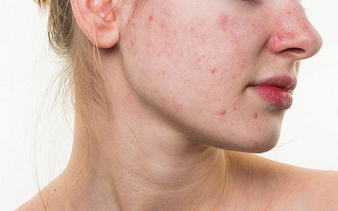 Ba cách nhận biết da nhạy cảm