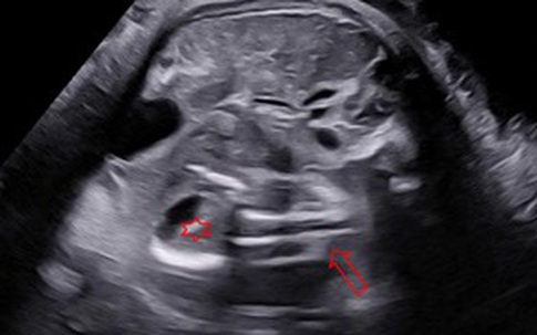 Từ trường hợp bé 1 tuổi mang bào thai trong não, hiện tượng thai trong thai được lý giải theo y học hiện đại