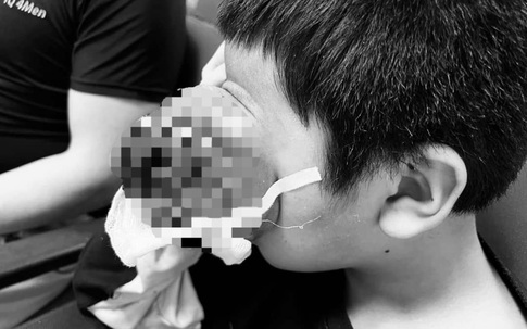 Hiếm gặp: Cậu bé 4 tuổi bị u quái hốc mắt chiếm gần nửa bên mặt