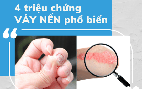 4 triệu chứng bệnh vảy nến khiến bạn mất ăn mất ngủ