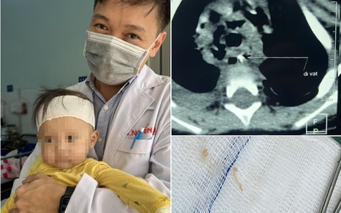 Bé 10 tháng tuổi suýt mất mạng sau khi ăn cháo lươn