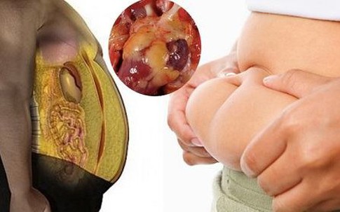 7 dấu hiệu sớm cảnh báo bạn bị gan nhiễm mỡ, đây là cách phòng ngừa bệnh hiệu quả nhất