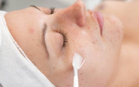 Trào lưu thay da hóa học trên TikTok ẩn chứa nhiều mối nguy hại