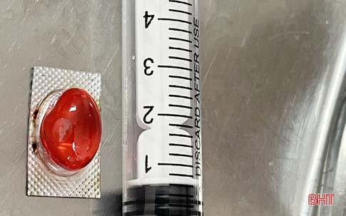 Hy hữu: Người đàn ông nhập viện vì uống thuốc quên bóc vỏ