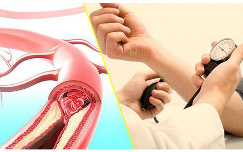 5 nhóm thực phẩm quen thuộc nhưng là "kẻ thù" của người bị cao huyết áp, nếu có 3 dấu hiệu này cần biết cách phòng bệnh
